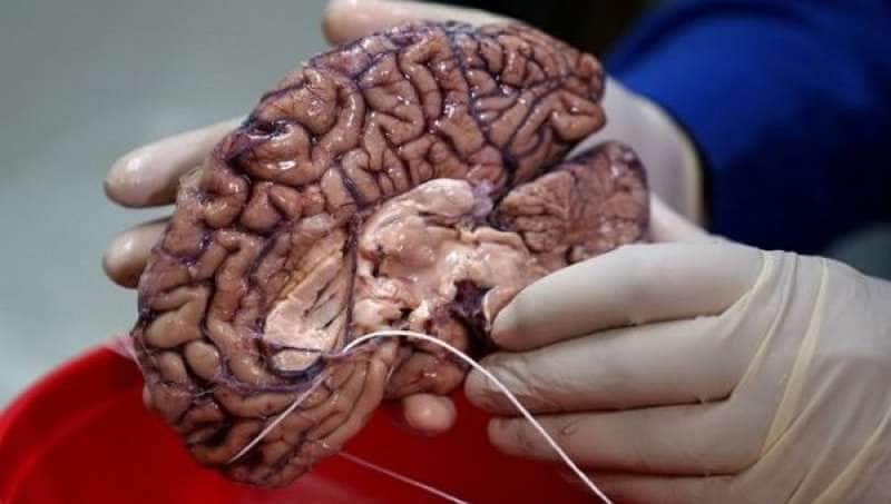 glioma tumore al cervello 1
