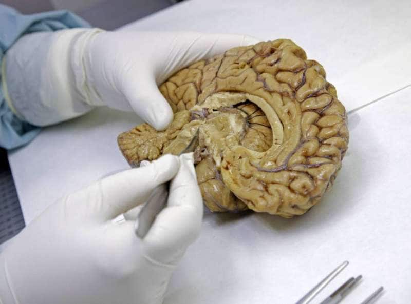 glioma tumore al cervello