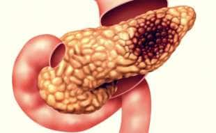 tumore al pancreas 14