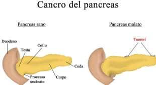 tumore al pancreas 8