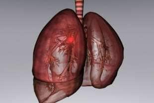 cancro ai polmoni 4