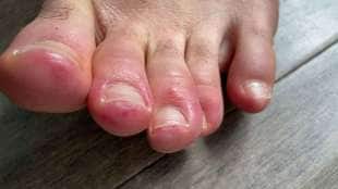 covid toe le dita dei piedi di chi si ammala di coronavirus 1