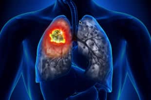 tumore del polmone