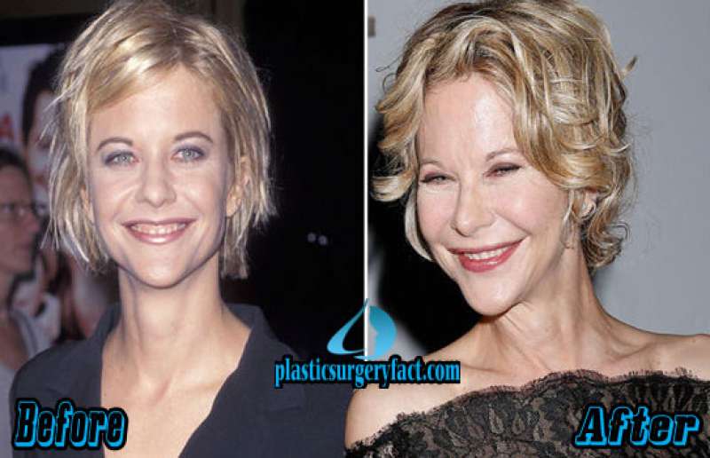 meg ryan ha trovato il giusto livello di botox - l'attrice ...