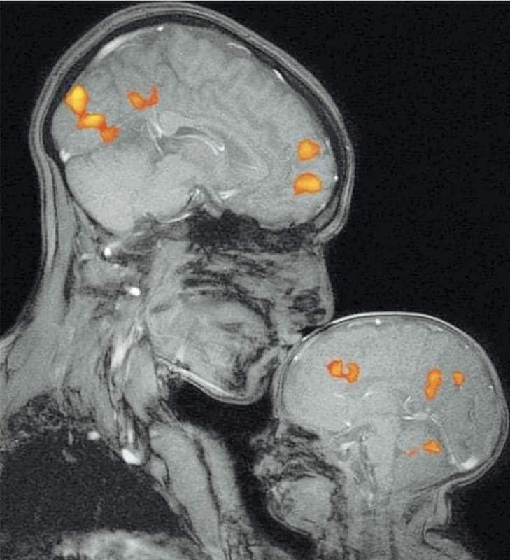 la risonanza magnetica che mostra il cervello di un bambino mentre la mamma lo bacia pubblicata da neurology