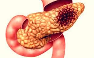 tumore al pancreas 10