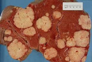 tumore al pancreas 13