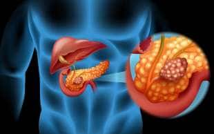 tumore al pancreas 7