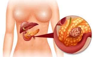 tumore al pancreas 9